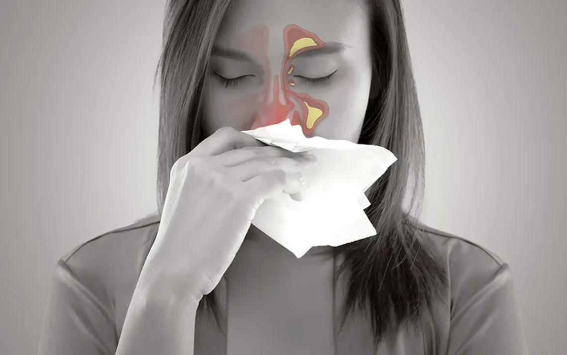 alergia nasal, congestão nasal, crise de rinite